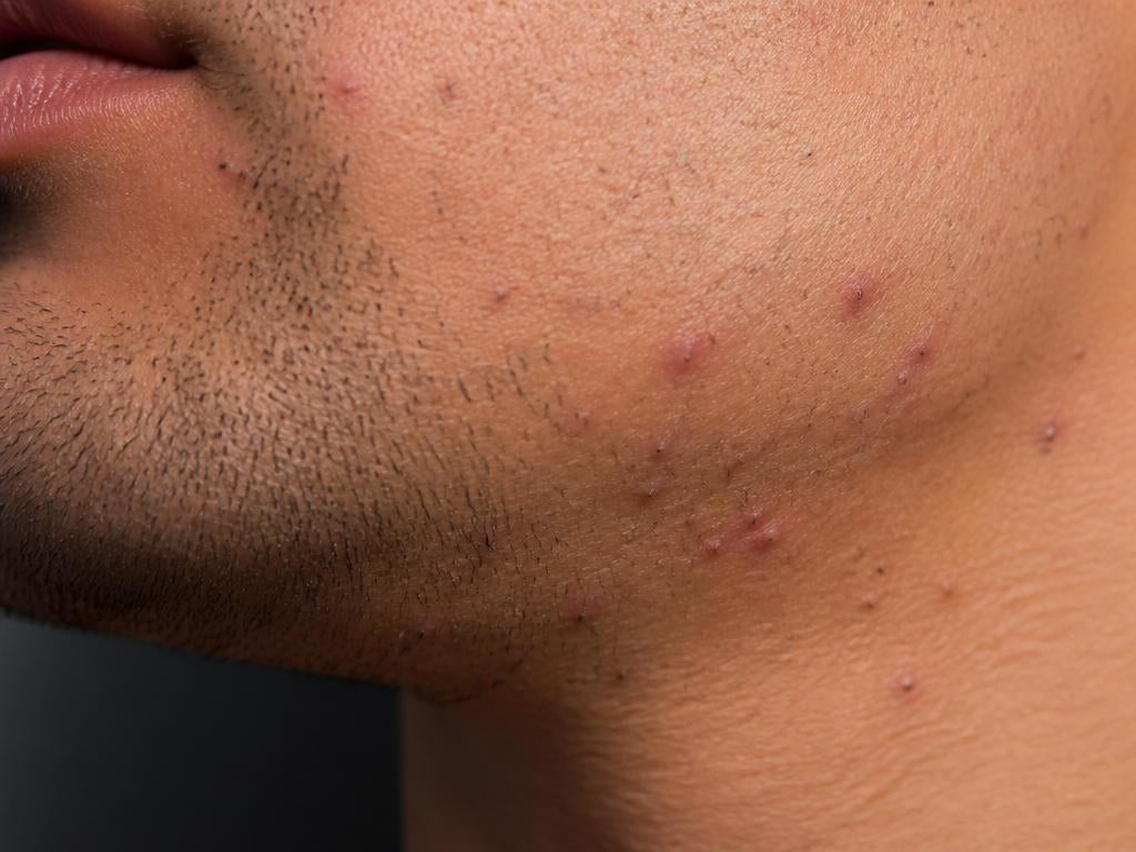 Jawline · ingrown-hair clearance — before treatment